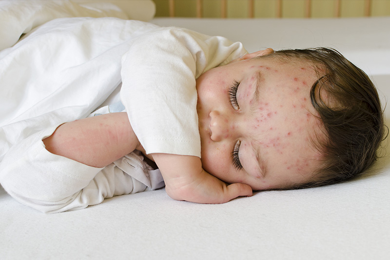 Chickenpox vaccination, chickenpox disease